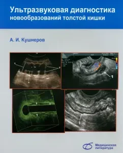 Ultrasound diagnosis of colon neoplasms: Alexander Kushnerov